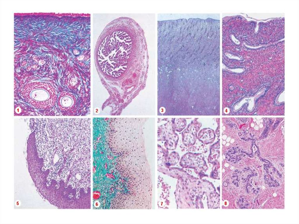 Трубная беременность микропрепарат. Микропрепарат гистология. Трубная беременность патологическая анатомия микропрепараты. Микропрепараты гистология. Цилиндрома кожи гистология.