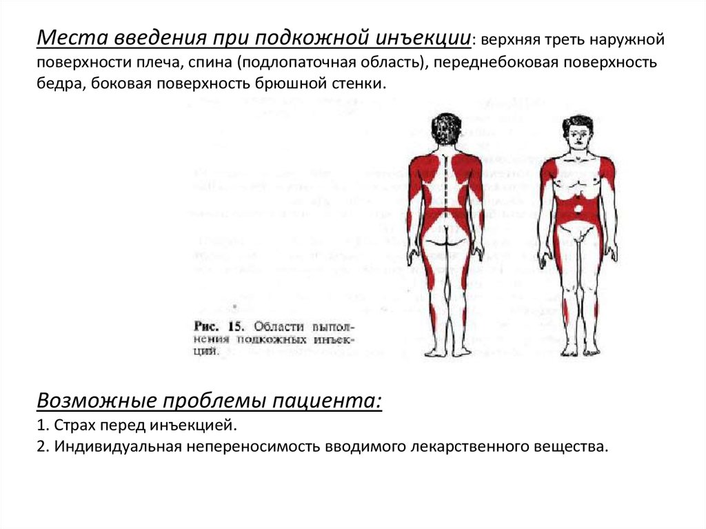 Отметьте на рисунке и напишите места для внутримышечных инъекций