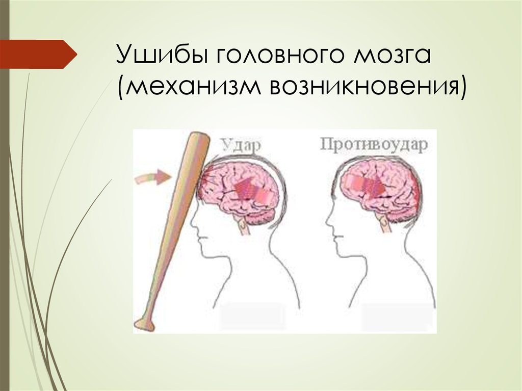 Небольшое сотрясение. Ушиб головного мозга механизм травмы. Черепно-мозговая травма сотрясение головного мозга. Травмы головного мозга у детей.