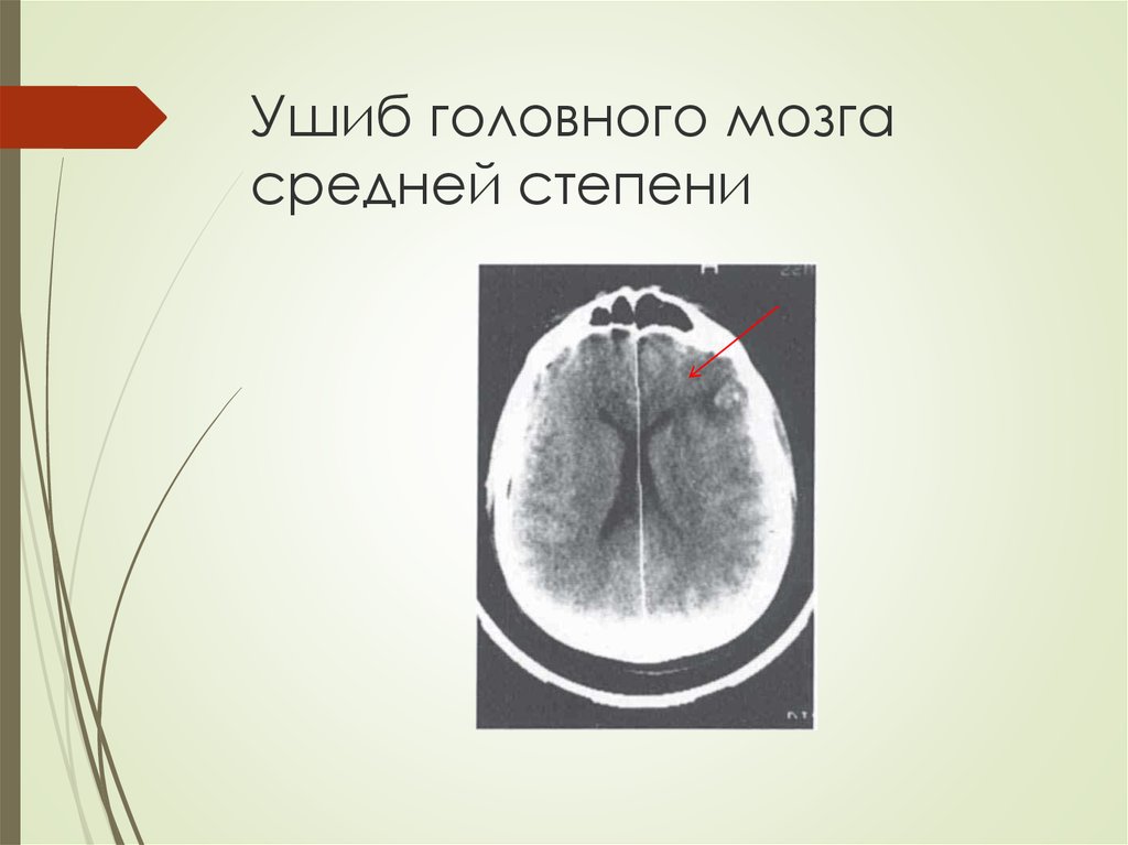 Ушиб головного мозга лечение. Ушиб головного мозга легкой степени. Ушиб мозга средней степени. Ушиб головного мозга средней степени тяжести кт.