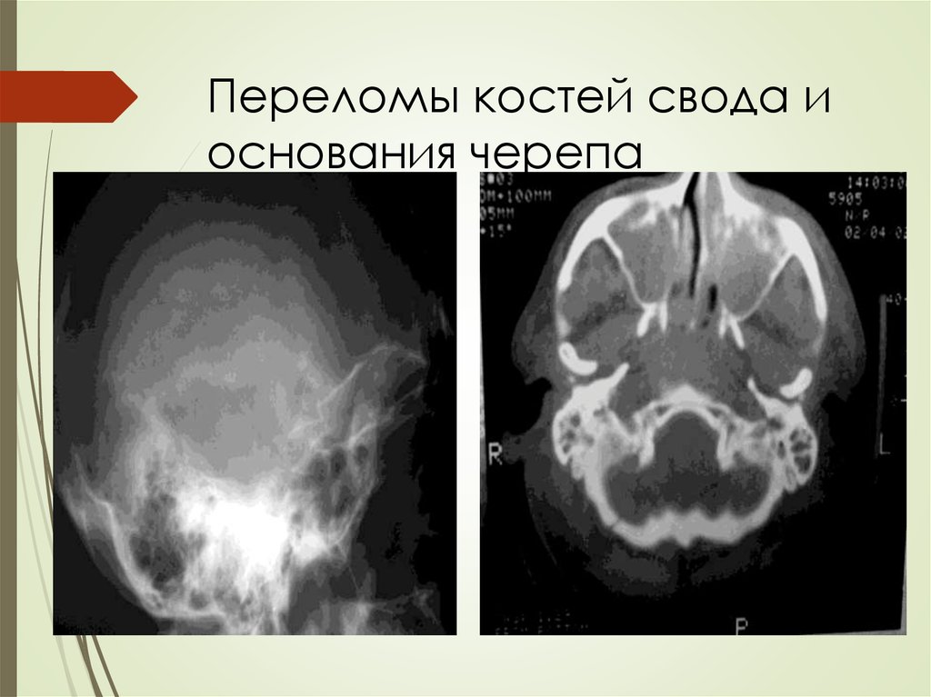 Перелом основания свода. Перелом кости свода черепа. Перелом свода основания черепа. Перелом кости свода и основания черепа. Перелом свода черепа, перелом основания черепа.