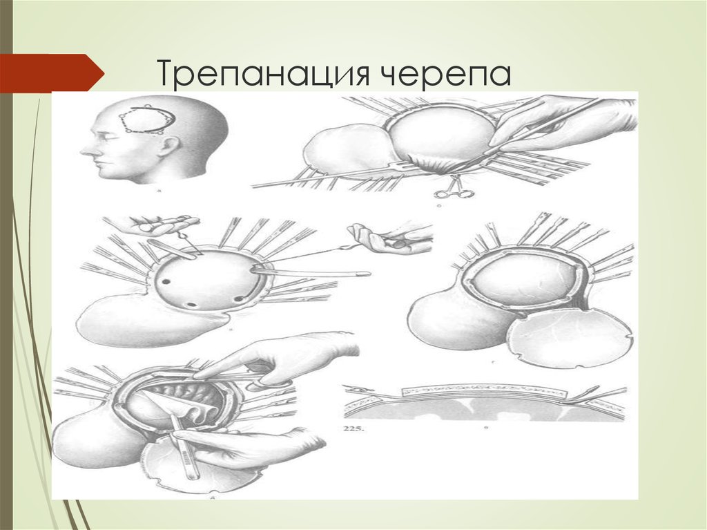 Трепанация. Для трепанации черепа используют. Трепанация по Вагнеру Вольфу. Трепанация черепа показания.