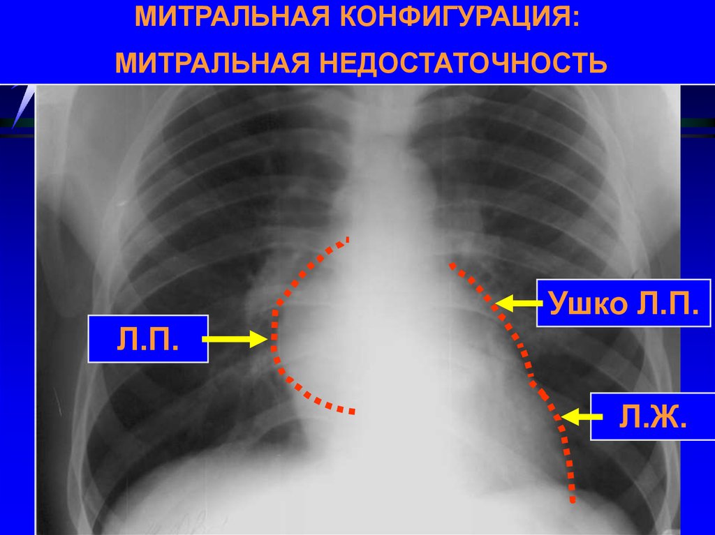 Митральное сердце. Митральная конфигурация сердца на рентгенограмме. Митральный порок сердца рентген. Митральная конфигурация сердца рентген. Митральный порок рентген признаки.