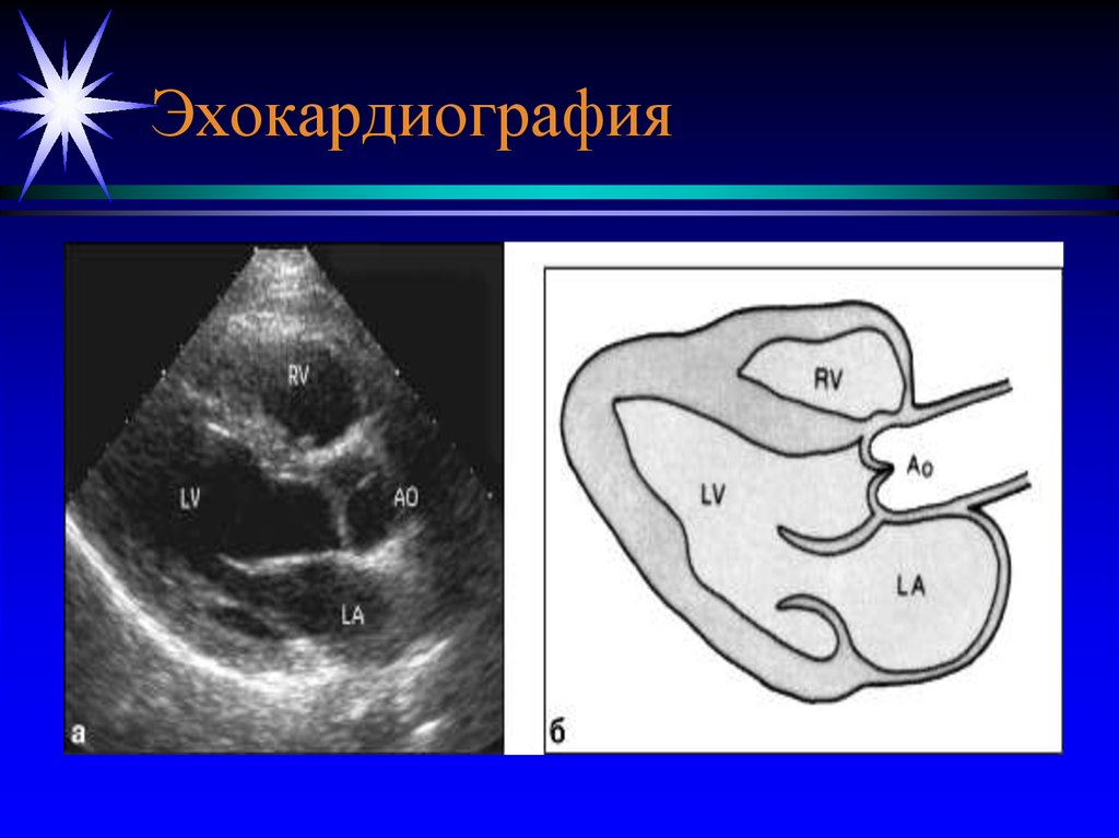 Эхо кг. Эхокардиография схема. Виды эхокардиографии. Эхокардиография плоскость. ЭХОКС что такое.
