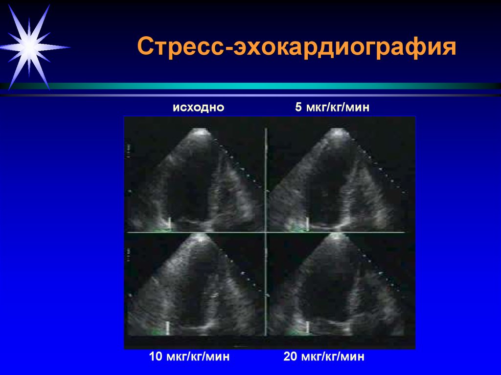 Эхокардиография. Стресс-эхокардиография (стресс-ЭХОКГ). Стресс эхокардиография клинические рекомендации. Стресс Эхо-кг сердца показания. Тресс-эхокардиографию.