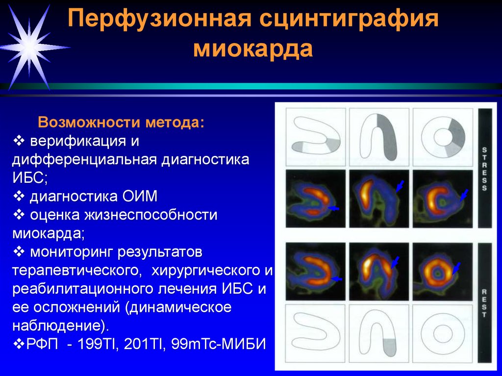 Сцинтиграфия миокарда. Нагрузочная сцинтиграфия миокарда. Кардио сцинтиграфия. Сцинтиграфия коронарных артерий. Сцинтиграфия при инфаркте миокарда.