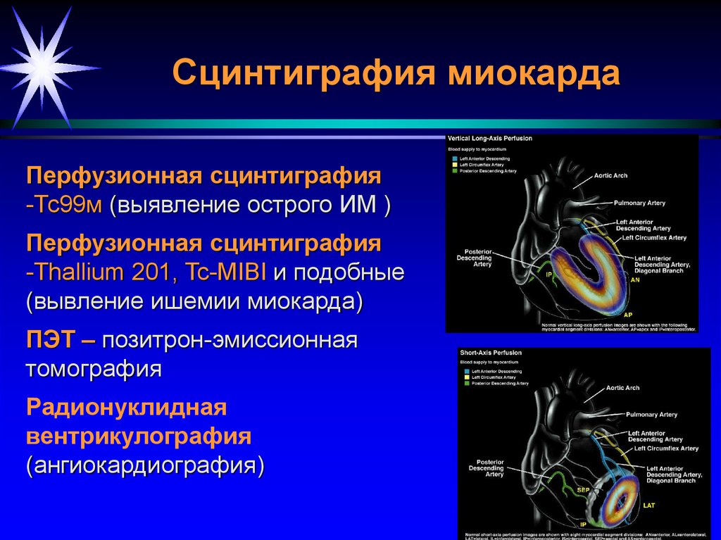 Сцинтиграфия миокарда. Радионуклидная сцинтиграфия миокарда. Перфузионная томосцинтиграфия миокарда. Сцинтиграфия миокарда с технецием. Перфузионная сцинтиграфия миокарда презентация.