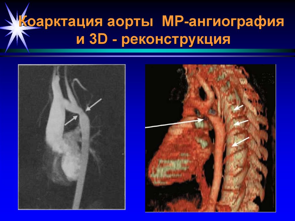 Коарктация аорты фото