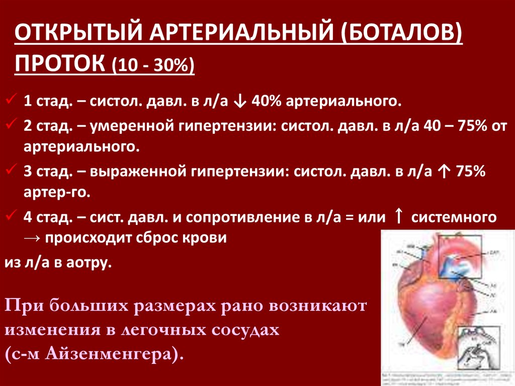 Открытый артериальный проток схема