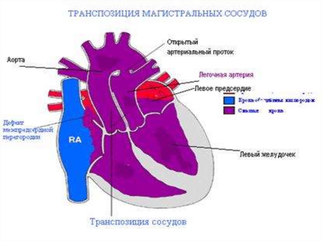 Транспозиция магистральных артерий презентация