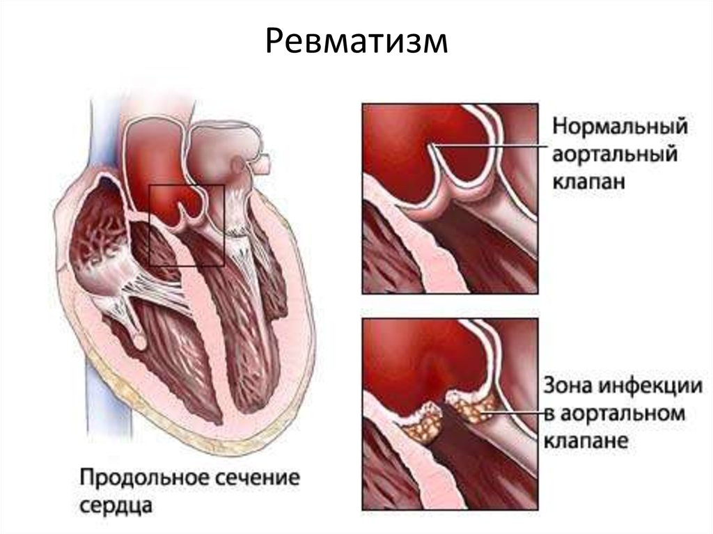 Презентация эндокардиты у детей