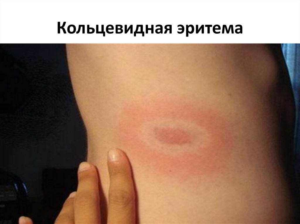 Кольцевидная эритема