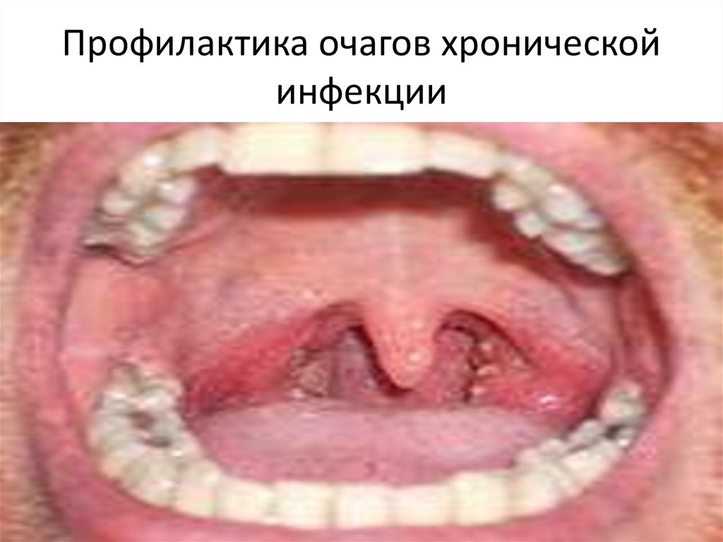 Профилактика очагов хронической инфекции