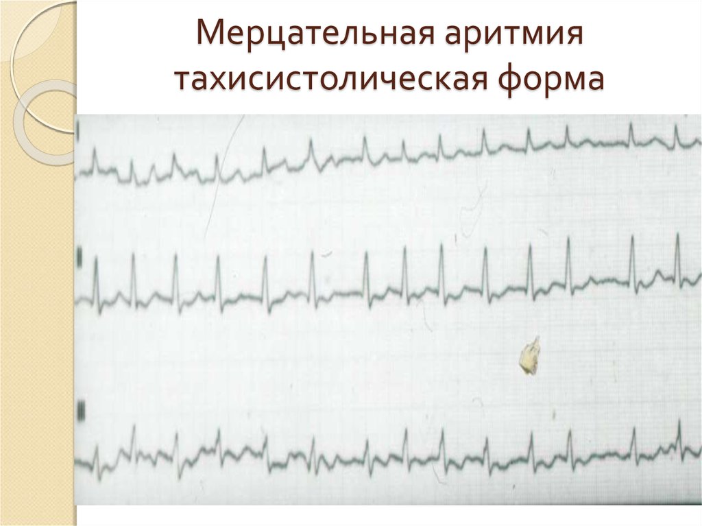 Ибс мерцательная аритмия карта вызова