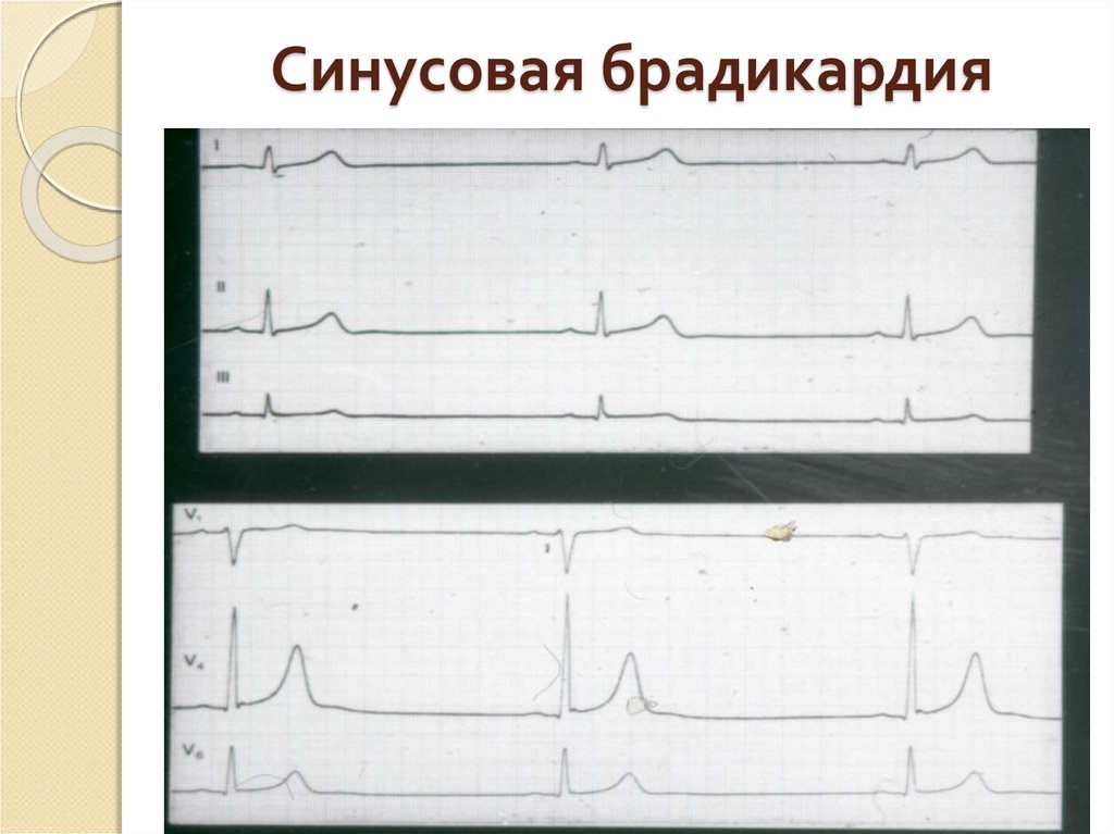 Умеренная синусовая брадикардия у ребенка. Брадикардия на ЭКГ. Синусовая брадикардия на ЭКГ. Синусовая брадикардия физиологическая. Экстремальная синусовая брадикардия.