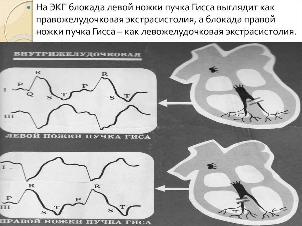 Экг блокады тест. Левожелудочковая блокада. Правожелудочковая сердечная блокада.