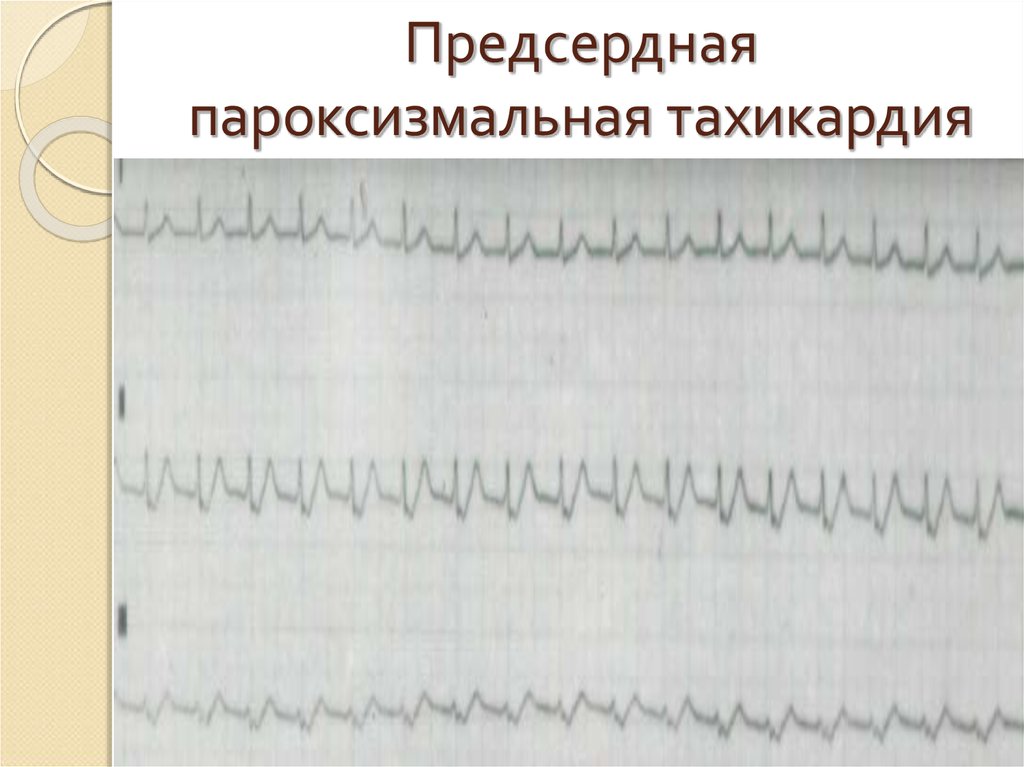 Предсердная тахикардия. Многофокусная пароксизмальная тахикардия. Пароксизмальная предсердная тахикардия. ИБС пароксизмальная тахикардия. Предсердная тахикардия с вариабельным проведением.