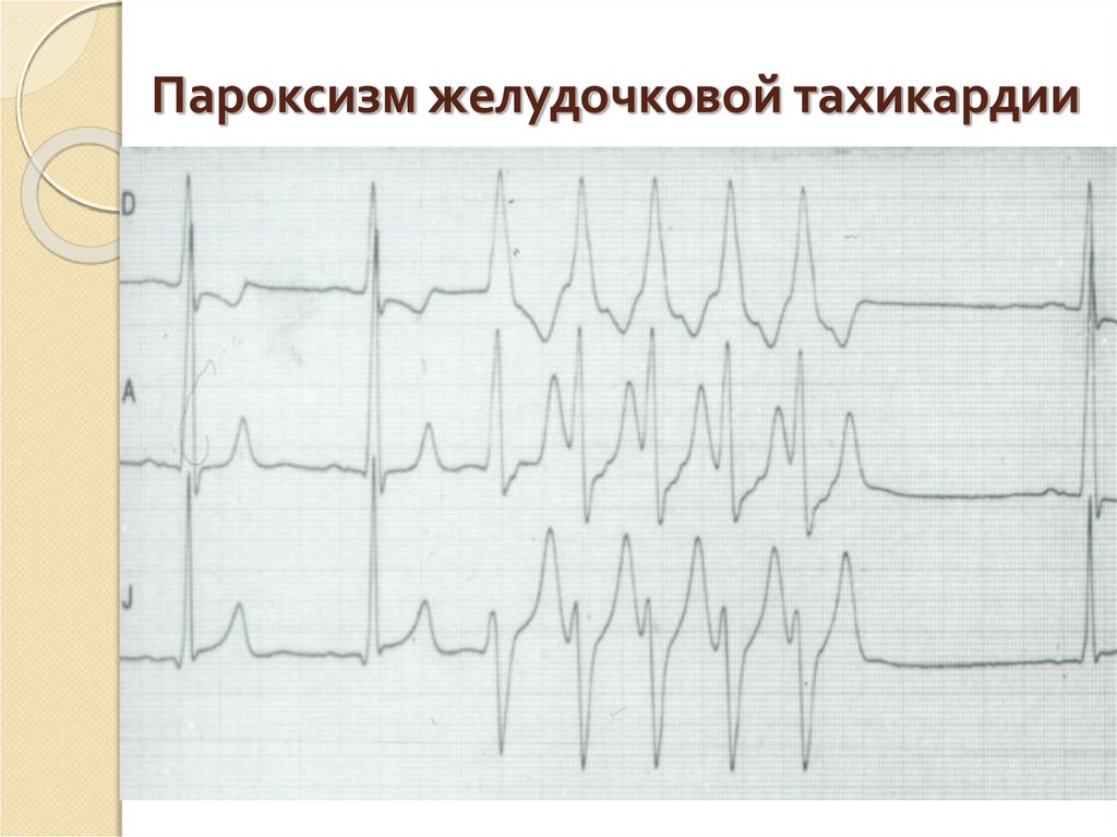 Желудочковая тахикардия на экг. Пароксизм желудочковой тахикардии ЭКГ. Пароксизмальная желудочковая тахикардия. Пароксизм ЖТ на ЭКГ. При пароксизмальной желудочковой тахикардии:.