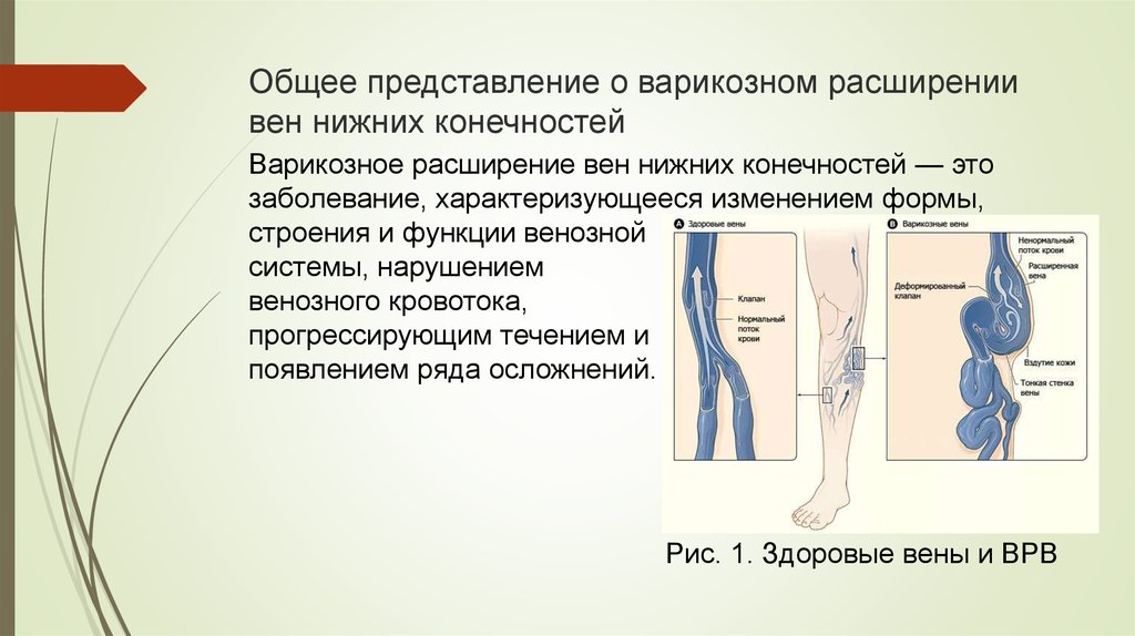 Кровотечение из варикозно расширенных вен нижних конечностей карта вызова скорой