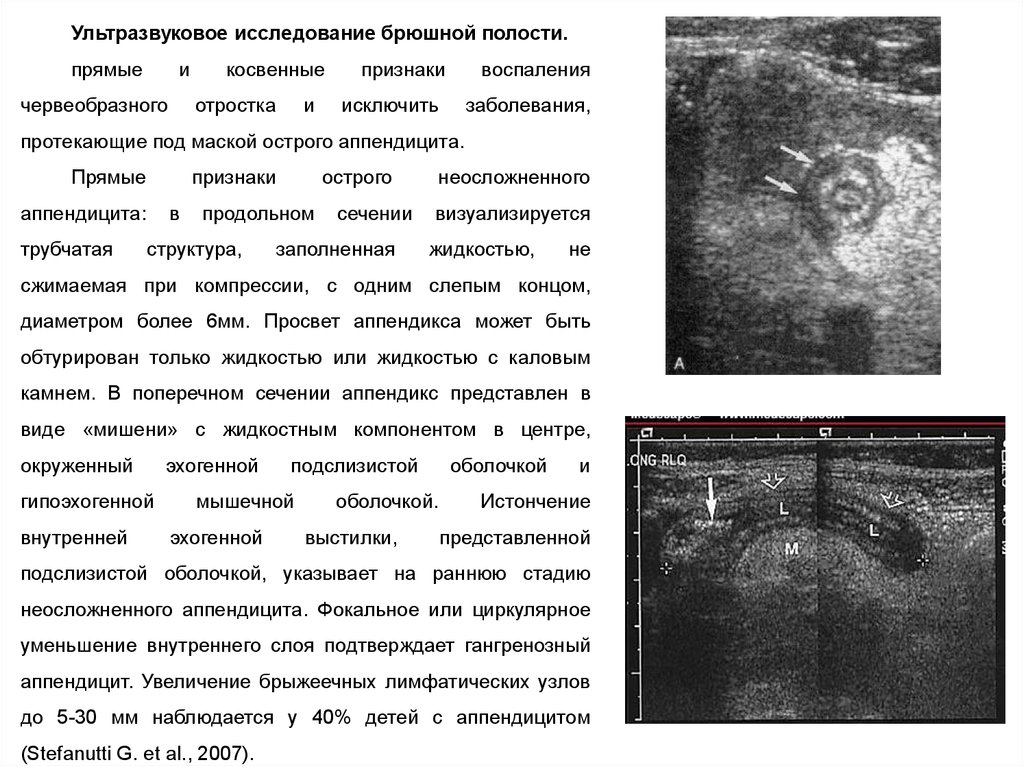 Ли узи брюшной полости. УЗИ при остром флегмонозном аппендиците. Флегмонозный аппендицит УЗИ протокол. УЗИ при остром флегмонозном аппендиците заключение. Острый аппендицит на УЗИ протокол.