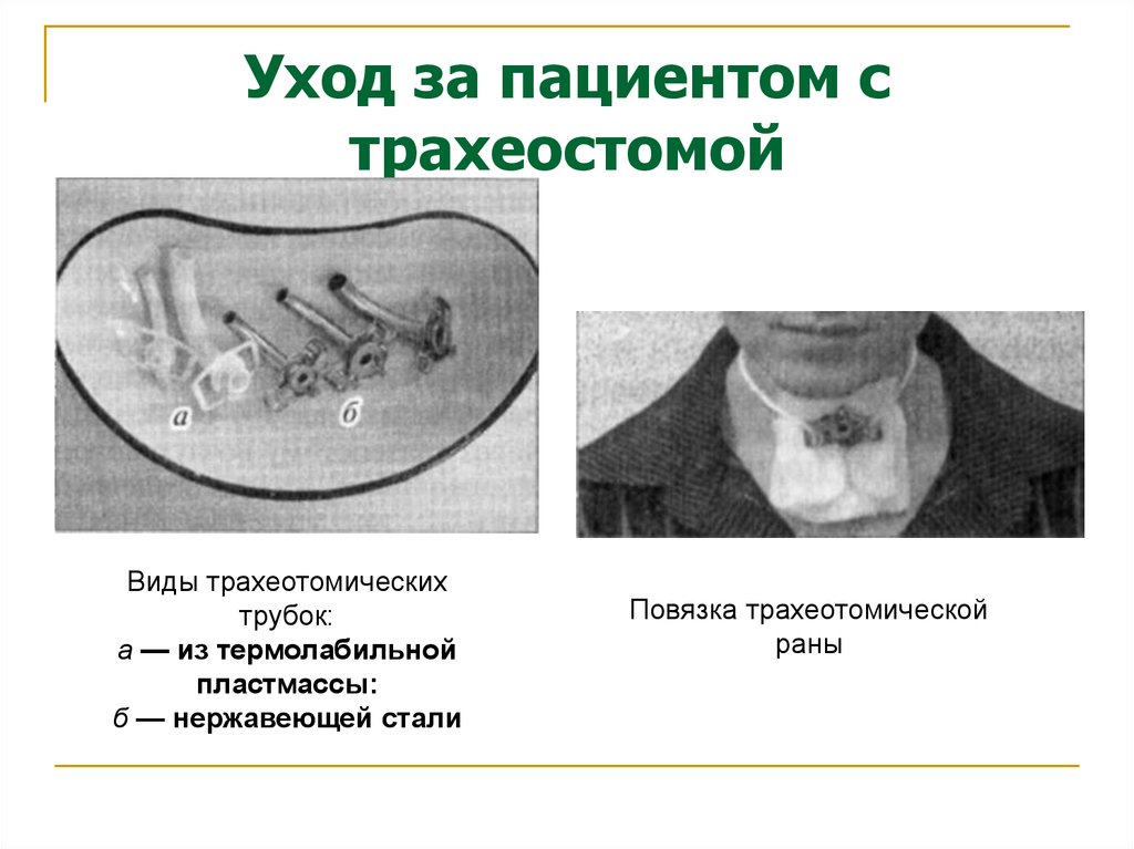 Уход за трахеостомой презентация