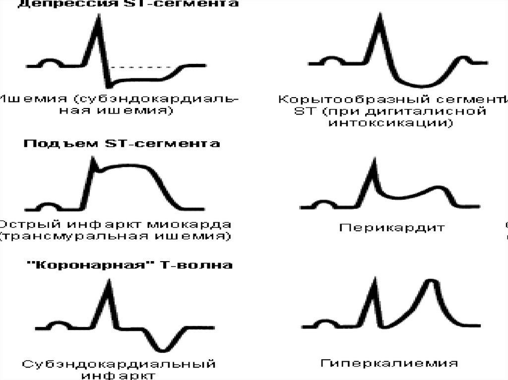 Экг картинка как снимать