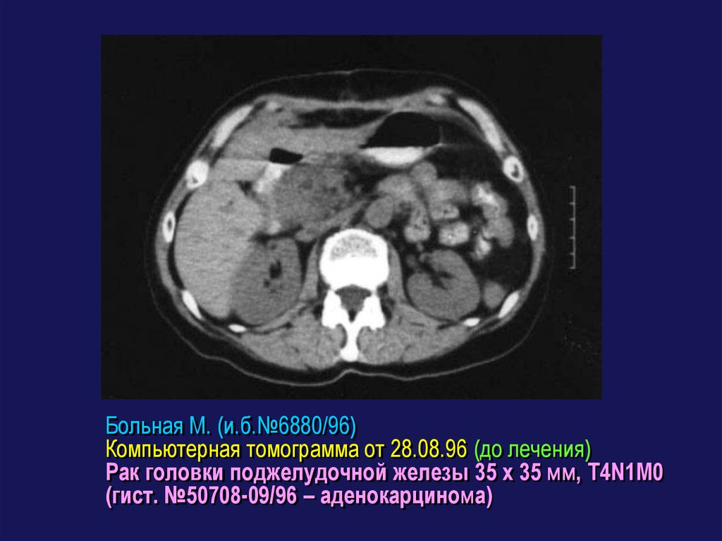 Опухоль головки поджелудочной железы прогноз. Аденокарцинома поджелудочной железы кт. Карцинома поджелудочной железы кт. Опухоль головки поджелудочной железы на кт. Аденокарцинома головки поджелудочной железы кт.