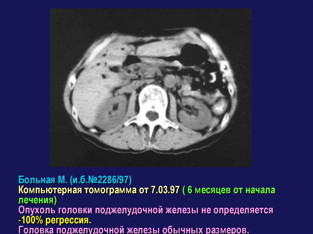 Опухоль головки поджелудочной железы. Опухоль головки поджелудочной железы на кт. Метастаз в головки поджелудочной железы на кт. Размеры головки поджелудочной железы кт. Оментит кт.