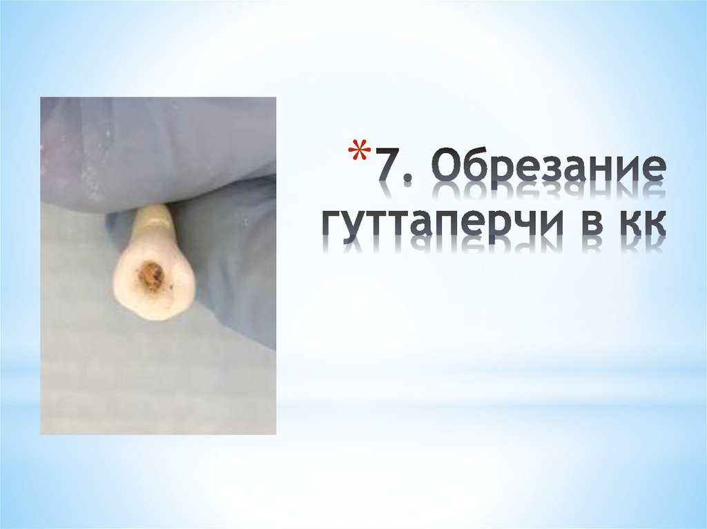 7. Обрезание гуттаперчи в кк