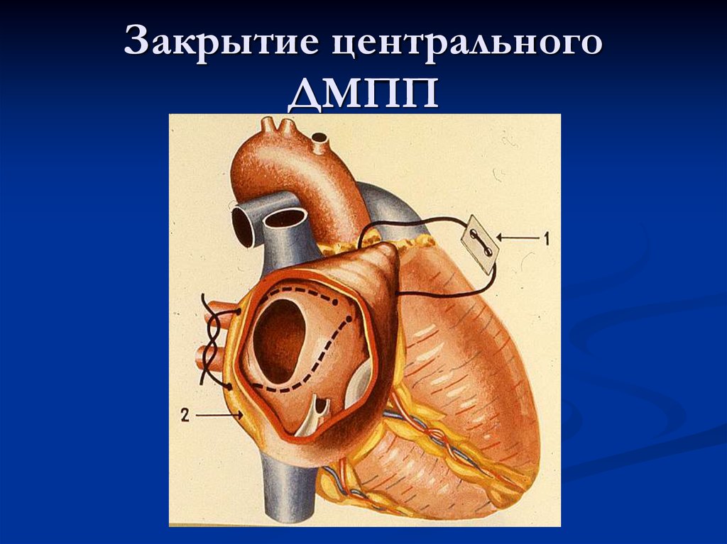 Дмпп у детей презентация