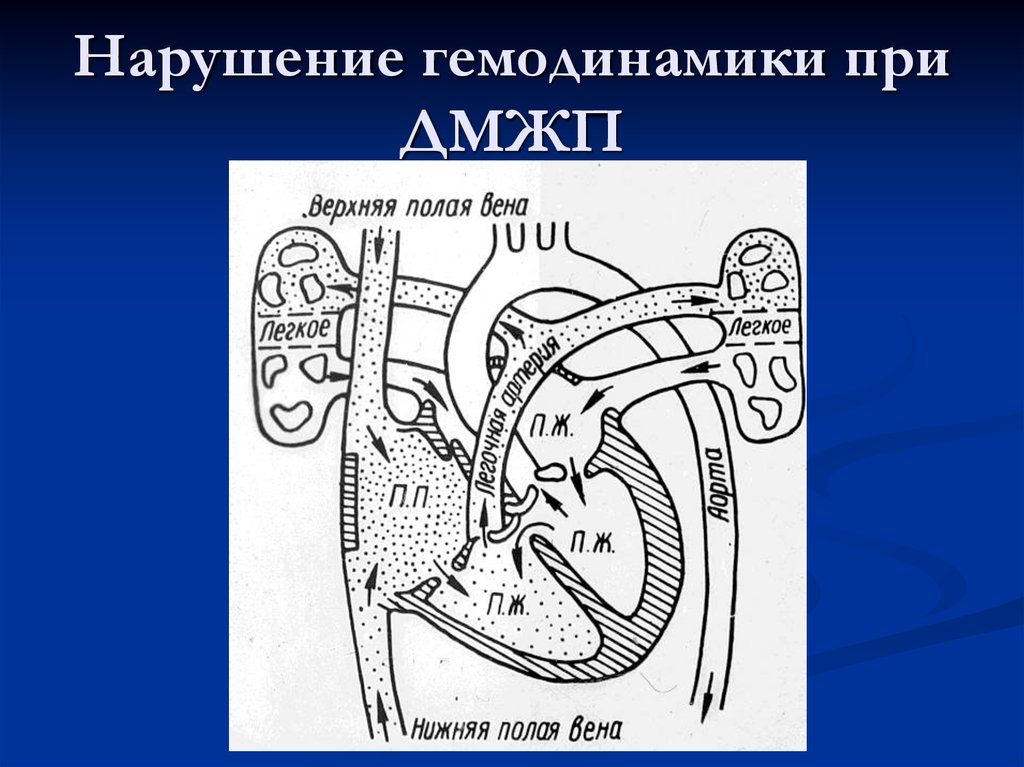 Дефект межжелудочковой перегородки гемодинамика схема