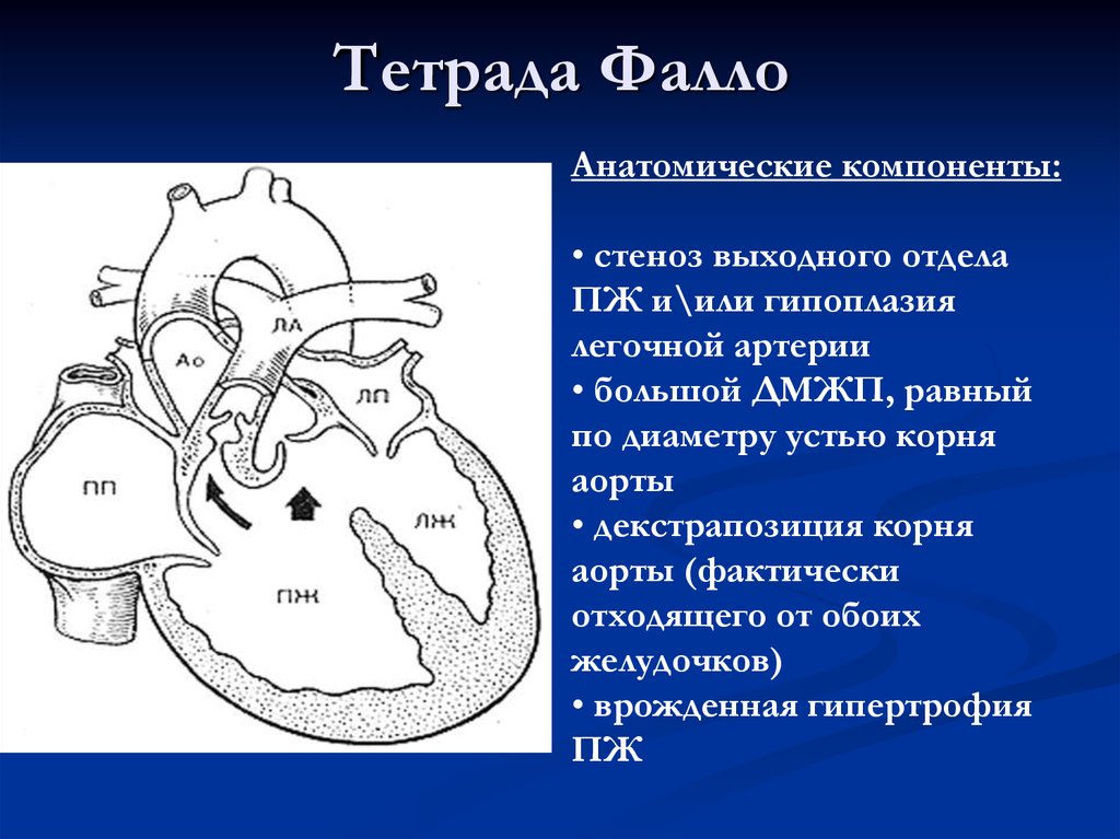 Тетрада фалло это. Врожденные пороки сердца болезнь Фалло. Врожденный порок сердца Тетрада Фалло у детей. 1 Тип тетрады Фалло.