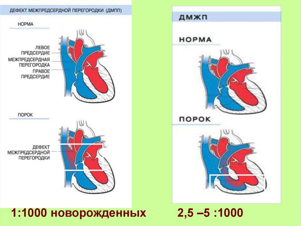 Операция межпредсердной перегородки. Дефект межжелудочковой перегородки гемодинамика схема. Гемодинамика при межпредсердной перегородки. Дефект межпредсердной перегородки гемодинамика схема. ВПС вторичный дефект межпредсердной перегородки.