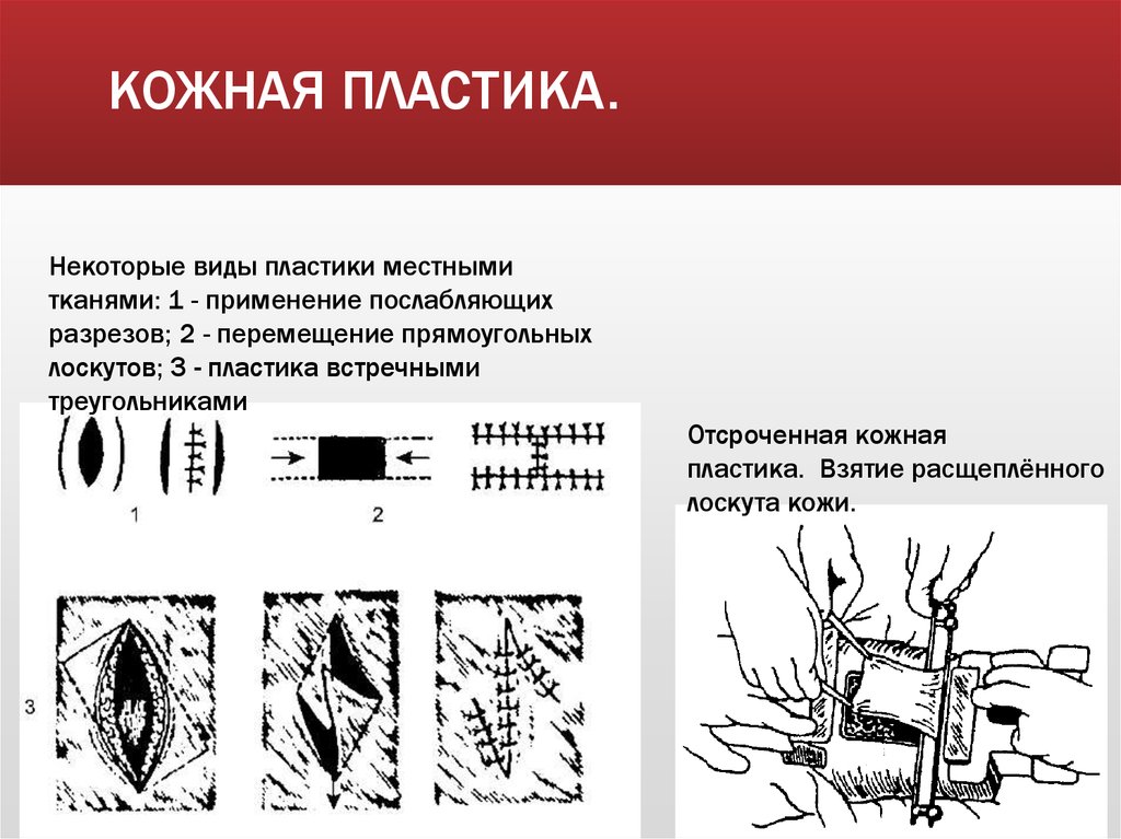 Пластика местными тканями презентация