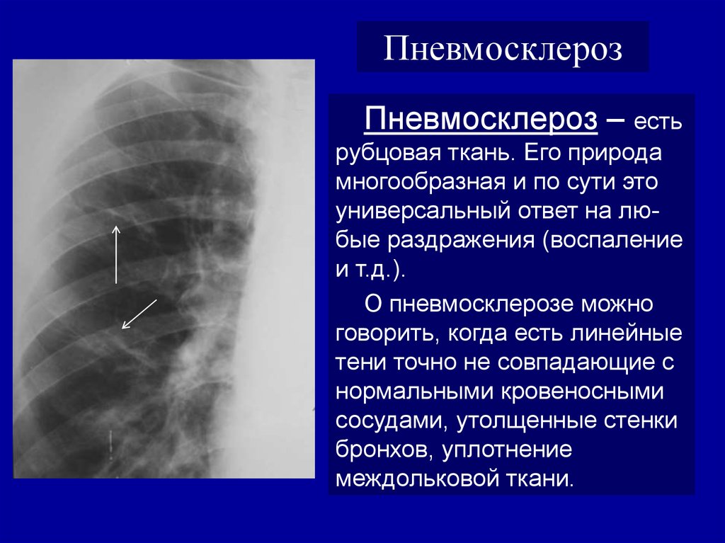 Что означает фиброзное изменение. Пневмосклероз легких это на рентгене лёгких. Диффузный пневмосклероз рентген. Пневмосклероз рентген признаки. Рентген признаки пневмофиброза.