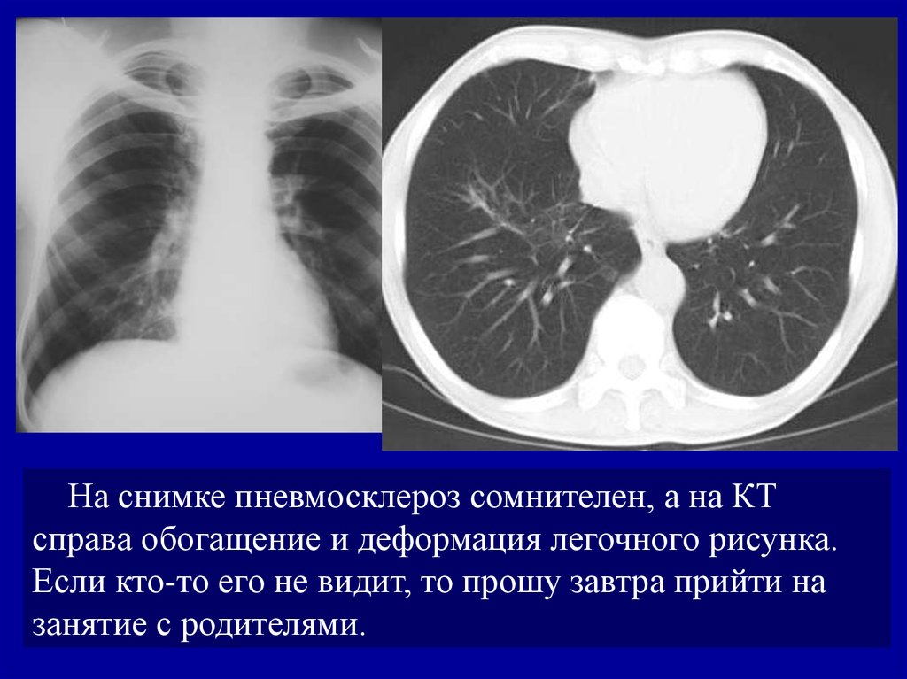 Пневмосклероз это простыми словами. Диффузный пневмофиброз кт. Диффузный пневмосклероз кт. Пневмосклероз лёгких на кт. Пневмосклероз легких кт.