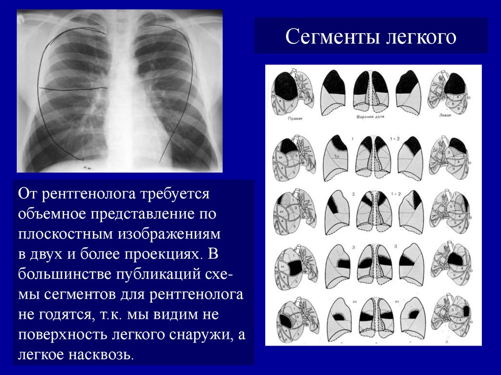 Что означает изменения в легких. Сегменты s1 s2 легких. Пневмония s8 s9 левого легкого. Язычковые сегменты рентген. S6 легкое сегмент.