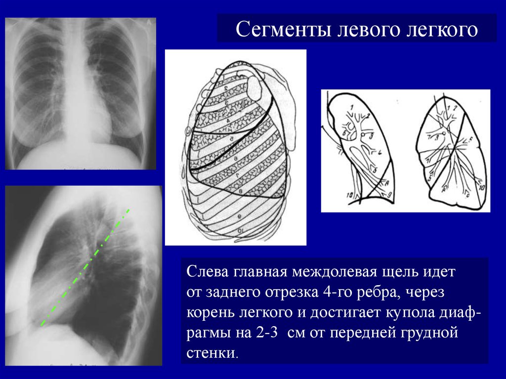 Язычковые сегменты левого. Сегменты левог олегког. Проекция долей легких на рентгенограмме. Доли легкого на рентгенограмме. Базальные отделы легких.