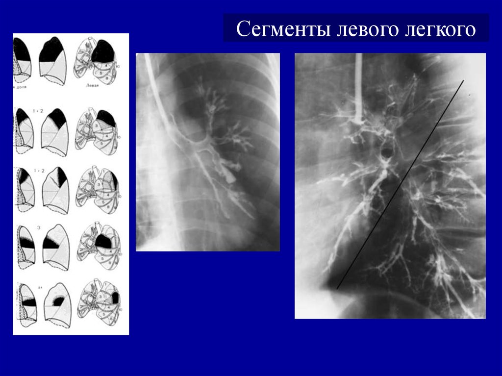 Язычковые сегменты левого. S10 сегмент левого легкого пневмония. 6 Сегмент левого легкого пневмония. Язычковые сегменты рентген. Сегмент s10 в левом легком.