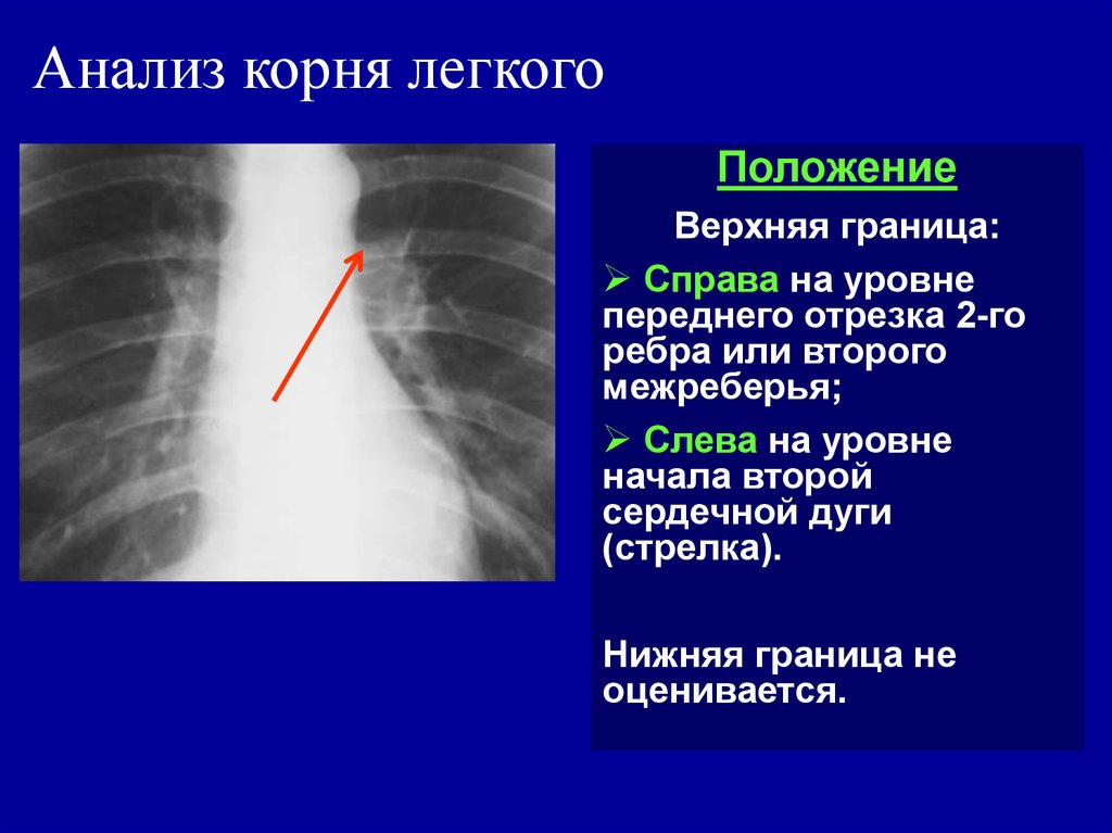 Органы корня легкого. Рентгенологические признаки прикорневой пневмонии. Корень легкого при пневмонии. Очаговая прикорневая пневмония.