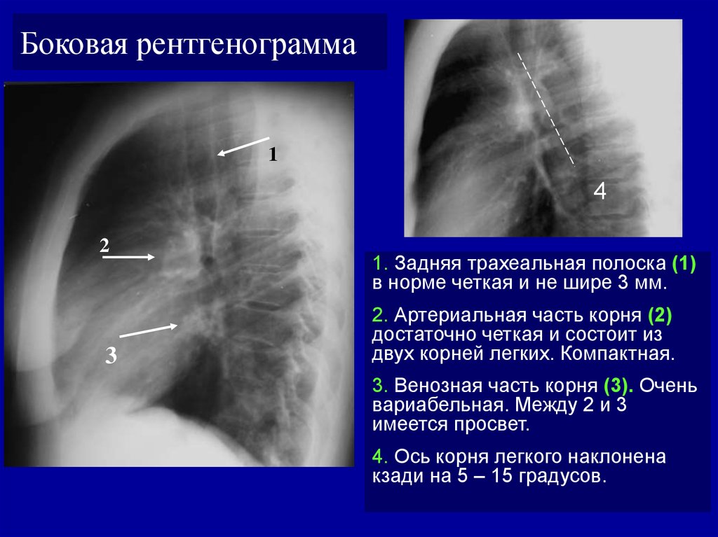 Анатомический субстрат легочного рисунка на рентгенограммах называется