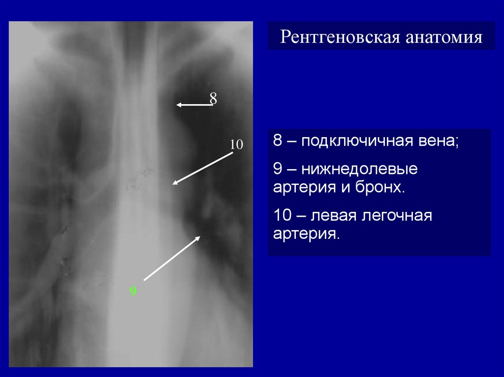 Анатомия рентген. Рентгеновская анатомия. Грудина анатомия рентген. Легочная артерия рентген анатомия. Надь рентгеновская анатомия.