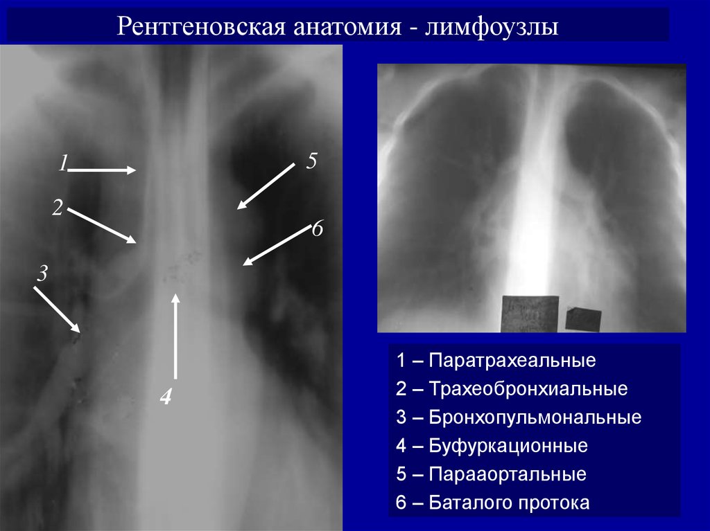 Анатомия рентген. Паратрахеальные узлы. Прелтрехальные лимфоузлы. Паратрахеальный лимфоузел. Паратрахеальные лимфатические узлы рентген.
