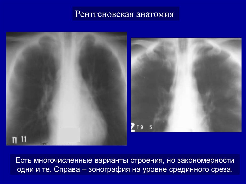 Анатомия рентген. Рентгенологическая анатомия. Рентген анатомия ССС. Зонография легких показания. Топографическая рентген анатомия.