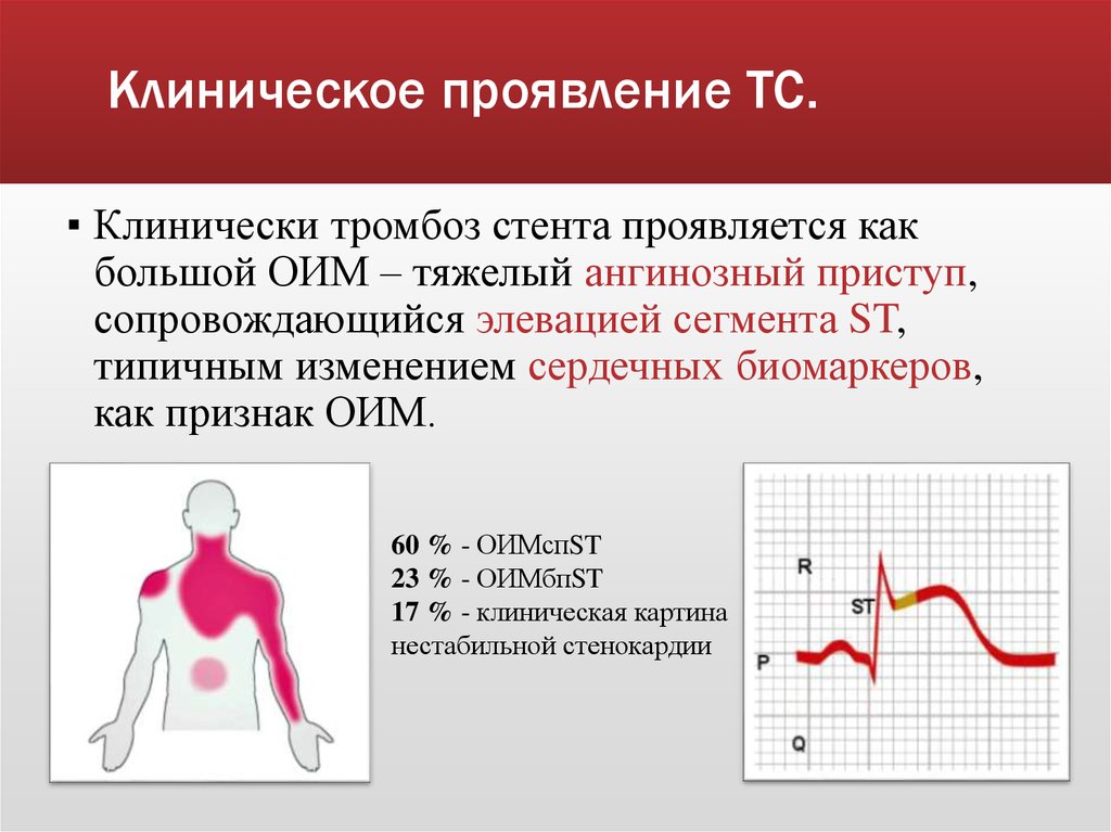 Клиническая картина нестабильной стенокардии