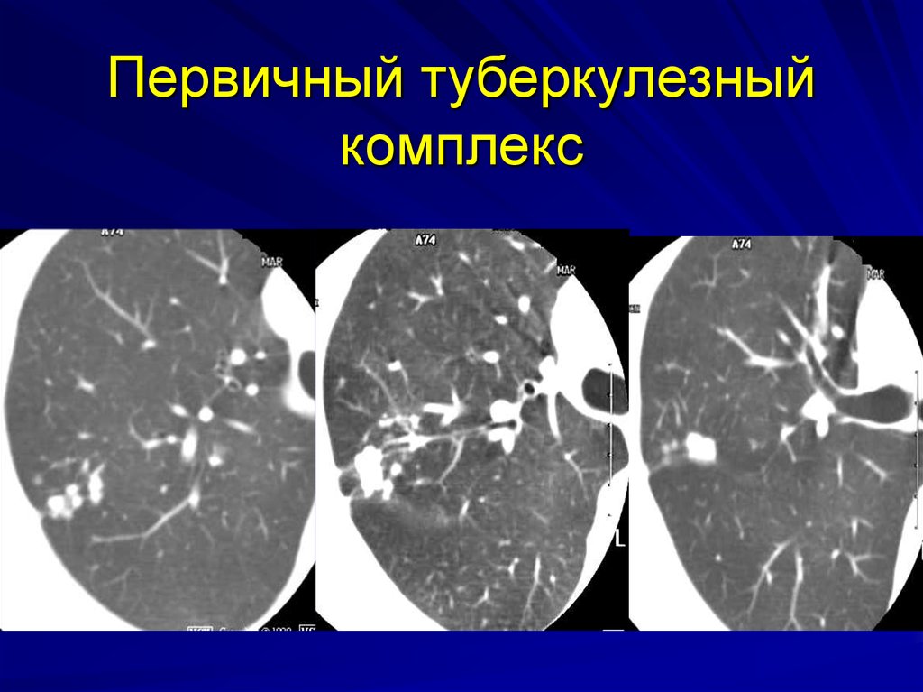 Очаговые изменения в легких на кт. Диссеминированный кавернозный туберкулез кт. Очаговый туберкулез туберкулез кт. Первичный туберкулезный комплекс на кт. Очаговый туберкулез компьютерная томография.