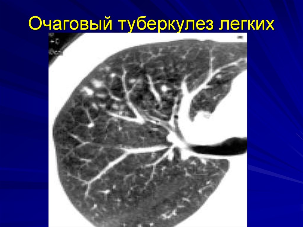 Очаговый туберкулез легких клиническая картина