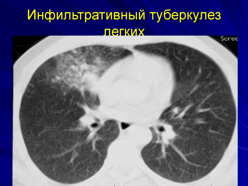 Картина кт при туберкулезе