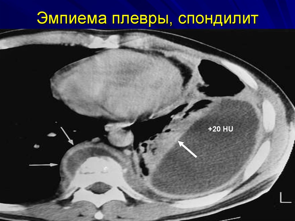 Мезотелиома плевры кт картина