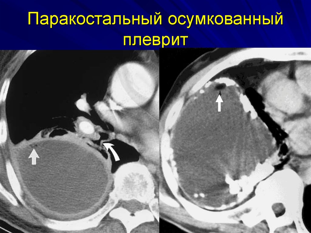 Гидроторакс на кт. Осумкованный плеврит на кт. Туберкулезный илеит на кт. Туберкулезный плеврит кт.